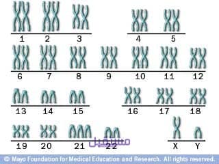 عدد كروموسومات شخص مصاب بمتلازمة داون